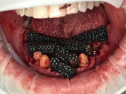 shining-intraoral-photogrammtery-416x312